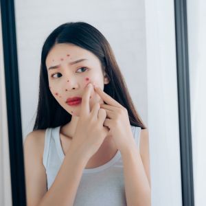痘痘位置圖解｜臉頰額頭下巴長痘原因與內分泌失調一次看懂